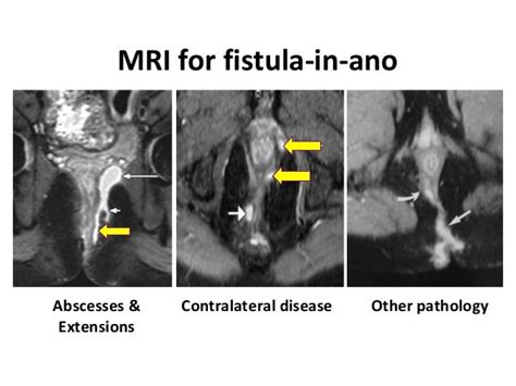 Fistula in-ano