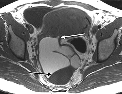 Nonovarian Cystic Lesions Of The Pelvis Radiographics