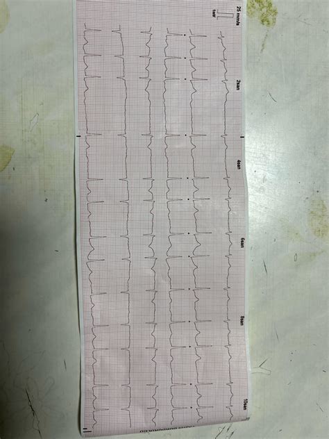 Which type of av block? : r/EKGs