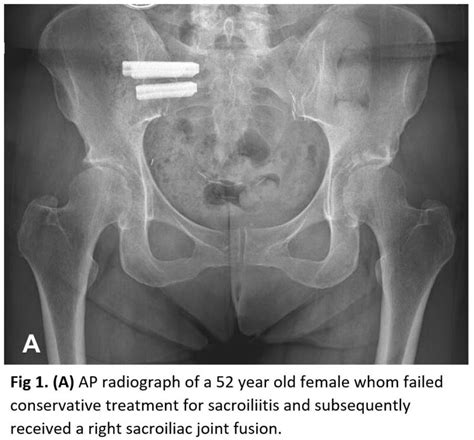 Sacroiliac Joint Xray