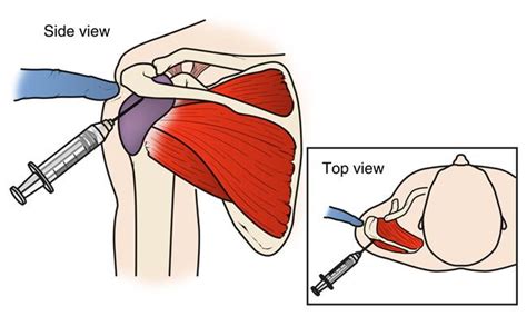 Rotator Cuff Tears Orthoinfo Aaos