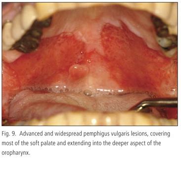 Pemphigus Vulgaris Medlibes Online Medical Library