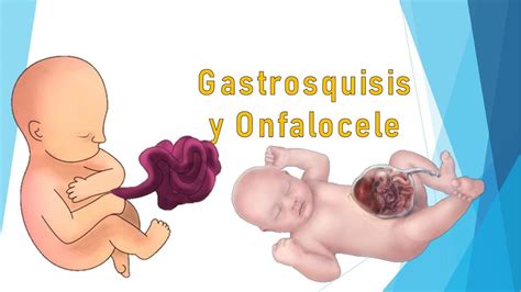 SpotlightMed Onfalocele Y Gastrosquisis SpotlightMed 56 OFF