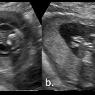 Ultrasound At Weeks Of Pregnancy Showing Septal Cervical Cystic