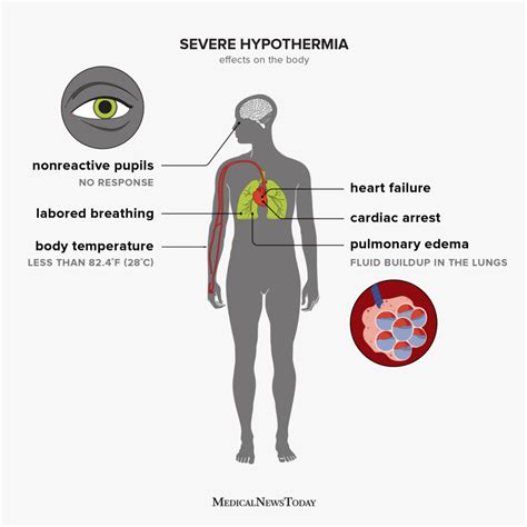 Hypothermia Symptoms Treatment Stages And More