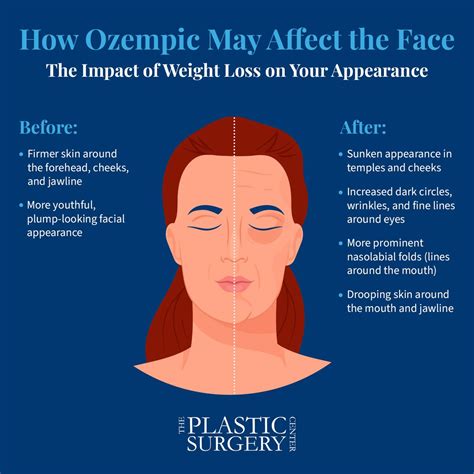 What Is Ozempic Face How To Fix Post Ozempic Facial Drooping