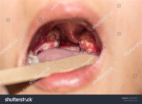 Large Tonsils Hot Sex Picture