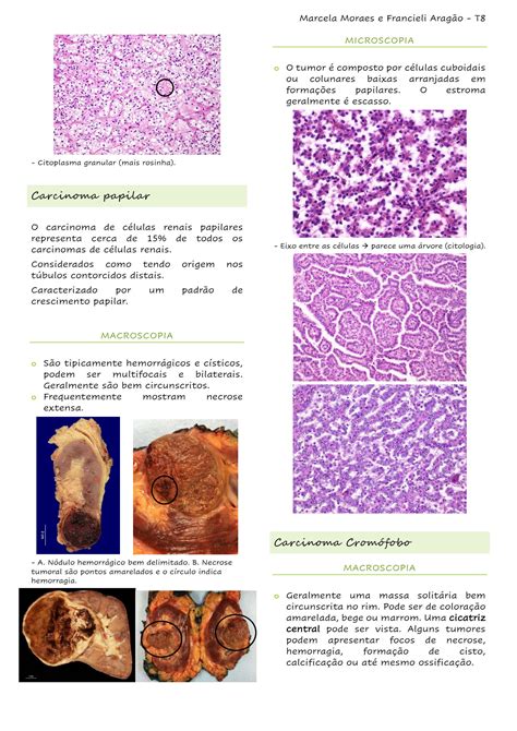 Solution Neoplasias Renais E Urol Gica Studypool