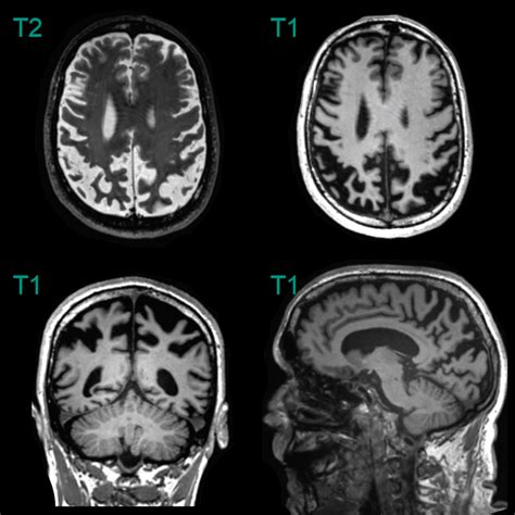 Corticobasal Degeneration Cbd Neuroradiology