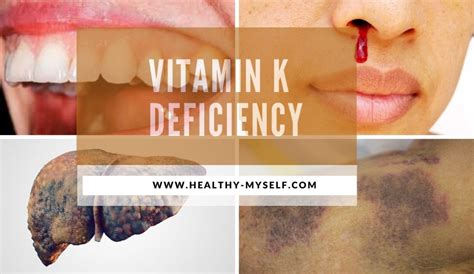 Vitamin k deficiency:Causes,Symptoms,Sources &Natural Remedies-2021