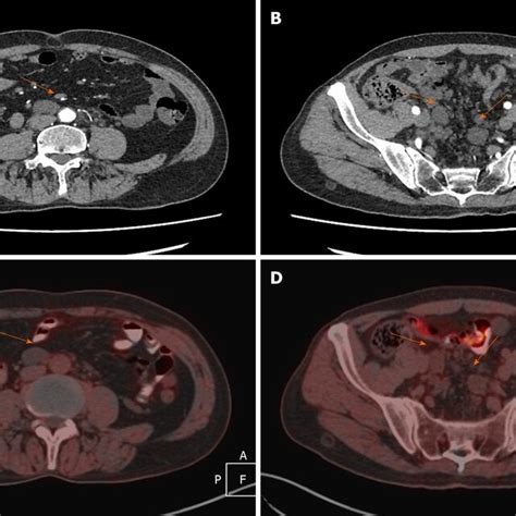 Contrast Enhanced Abdominal Pelvic Computed Tomography And Whole Body