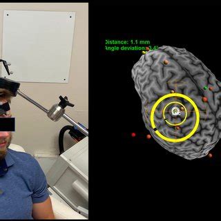 Magnetic Resonance Imaging Neuronavigation Guided Transcranial Magnetic