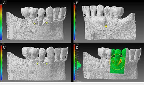 3d Views Of Pre And Post Operative Cone Beam Computed Tomography Cbct