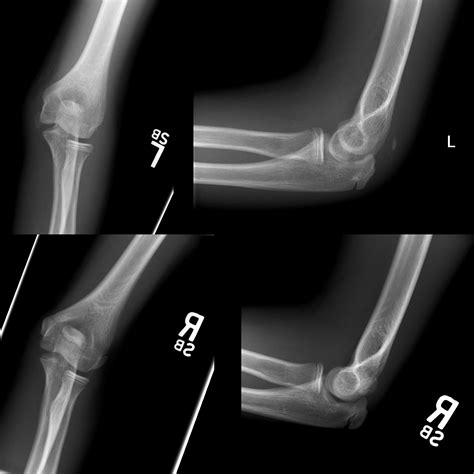 Elbow Fracture Pacs