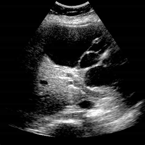 Biliary Cystadenocarcinoma Radiology Key