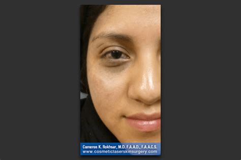 Nevus Of Ota Removal Before And After Photos • Dr Cameron Rokhsar