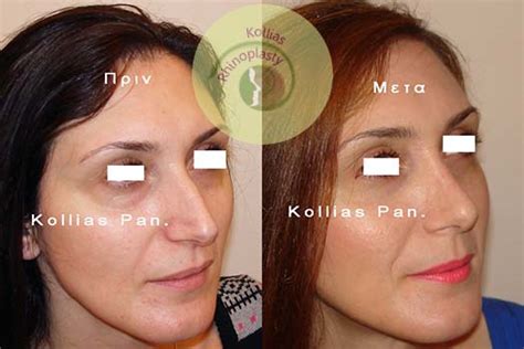 Rhinoplasty Over Development Nose 014 Π Κόλλιας