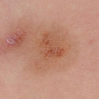 Granulomatous Changes Associated With Pigmented Purpuric Dermatosis ...