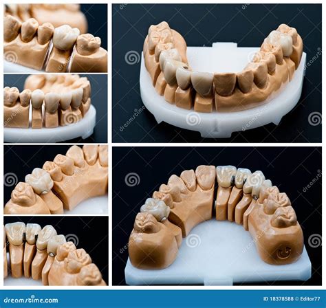 Dental Prosthesis Dentures Prosthetics Work Prosthetics Hands While