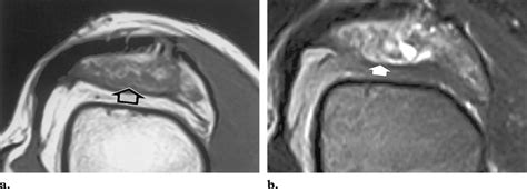 Synovial Hemangioma Of The Knee A Axial T1 Weighted Mr Image Shows