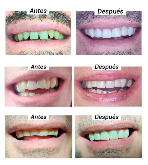 Carillas dentales de composite Clínica Dental Zahne