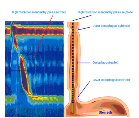 High Resolution Esophageal Manometry