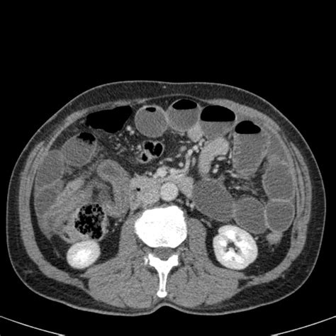 The Radiology Assistant Closed Loop Obstruction In Small Bowel Obstruction