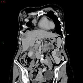 Contrast Enhanced Computed Tomography Of The Thorax Abdomen And