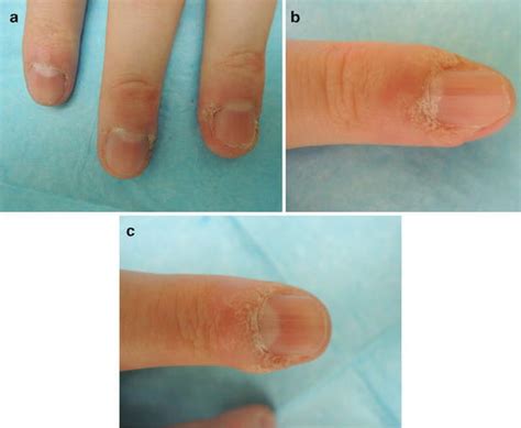 Subungual Warts