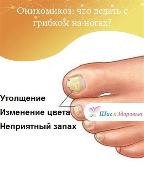 Симптомы грибка ногтей на ногах: какие первые признаки, виды и причины ...