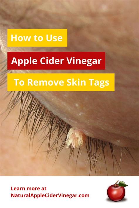 How To Use Apple Cider Vinegar To Remove Skin Tags Skin Tag Apple