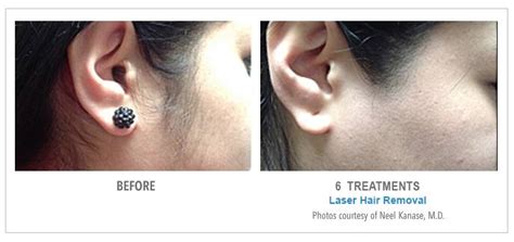 Before & After Photos - Laser Hair Removal | American Laser Med Spa - Texas