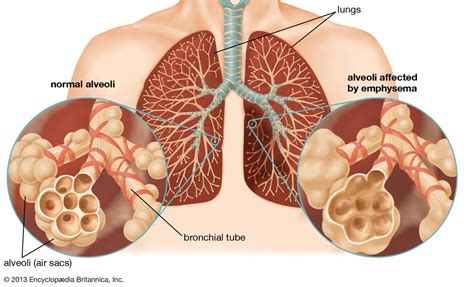 Doença Pulmonar Obstrutiva Crônica Dpoc Sintomas Causas E Tratamento