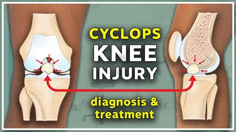 Cyclops Injury Of The Knee Diagnosis And Treatment YouTube