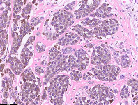 Invasive Melanoma Histology