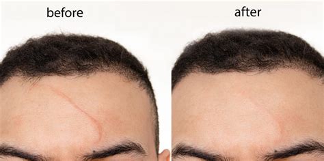 Things To Know Before Getting Laser Treatment For Your Scar