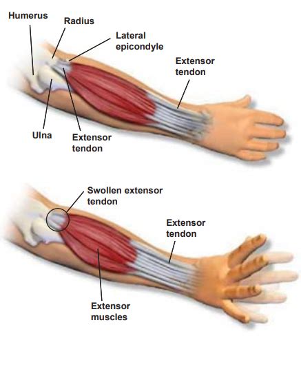 Nortex Spine And Joint Institute Lateral Epicondylitis