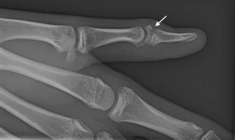 Thumb Distal Phalanx Pediatric Fracture Hand Surgery Source