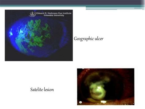 Corneal Ulcers