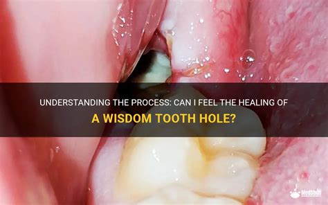 Understanding The Process Can I Feel The Healing Of A Wisdom Tooth Hole Medshun