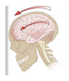 Brain Contusion: Treatment, Recovery & Long-Term Effects | Study.com