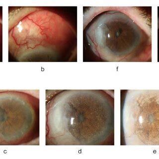 Photograph Of The Anterior Segment Of The Left Eye Fig 1a B Scleral