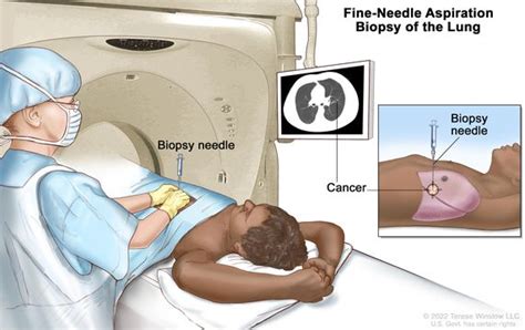 Definition Of Lung Biopsy Nci Dictionary Of Cancer Terms Nci