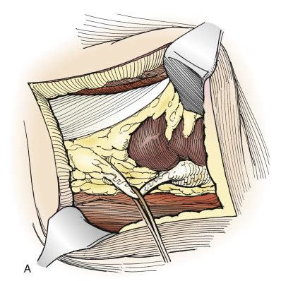 open pyeloplasty abdominal key