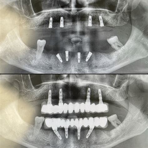 All On Dental Implants Turkey Cost Dental Clinic In Antalya