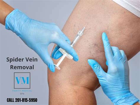 Varicose Spider Vein Removal In Paramus Nj Call Vanity Medical Spa Now