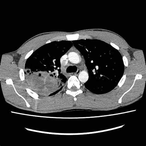 Lung Abscess • Litfl • Lung Ultrasound Library