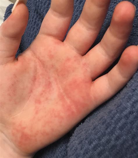 Palmoplantar Eruption In A Patient With Mercury Poisoning Mdedge Dermatology