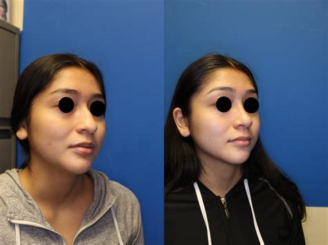 Nose Surgery Before And After Photos Patient 266 San Francisco Ca