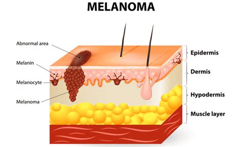 Melanoma - Medical Chart Help